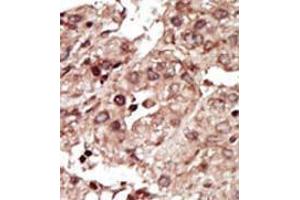 Formalin-fixed and paraffin-embedded human cancer tissue (hepatocarcinoma) reacted with the primary antibody, which was peroxidase-conjugated to the secondary antibody, followed by AEC staining. (PHKG1 抗体  (Middle Region))