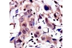 IHC analysis of FFPE human breast carcinoma tissue stained with the MUSK antibody (MUSK 抗体  (AA 35-65))