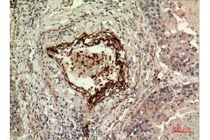 Immunohistochemistry (IHC) image for anti-Isocitrate Dehydrogenase 1 (NADP+), Soluble (IDH1) (N-Term) antibody (ABIN3187915)
