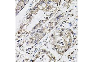 Immunohistochemistry of paraffin-embedded human gastric cancer using Carbonic Anhydrase 9 (C/G250) antibody (ABIN6131266, ABIN6137798, ABIN6137800 and ABIN6217767) at dilution of 1:100 (40x lens). (CA9 抗体  (AA 52-151))