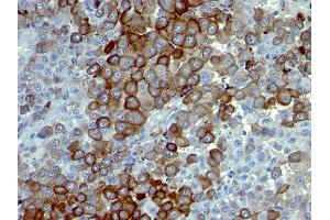 Formalin-fixed, paraffin-embedded human Melanoma stained with NGFR Monoclonal Antibody (NTR/912). (NGFR 抗体)