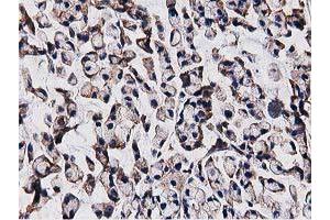 Immunohistochemical staining of paraffin-embedded Adenocarcinoma of Human colon tissue using anti-OGFOD1 mouse monoclonal antibody. (OGFOD1 抗体)