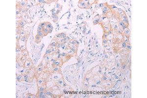 Immunohistochemistry of Human breast cancer using ADAMTS14 Polyclonal Antibody at dilution of 1:50