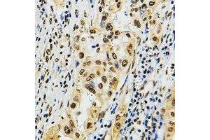 Immunohistochemical analysis of POLR3B staining in human lung cancer formalin fixed paraffin embedded tissue section. (POLR3B 抗体)