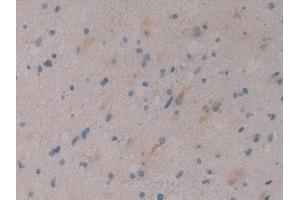 Detection of DKK3 in Human Glioma Tissue using Polyclonal Antibody to Dickkopf Related Protein 3 (DKK3) (DKK3 抗体  (AA 22-350))