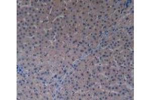 Detection of PAK1 in Human Liver Cancer Tissue using Polyclonal Antibody to p21 Protein Activated Kinase 1 (PAK1) (PAK1 抗体  (AA 252-501))