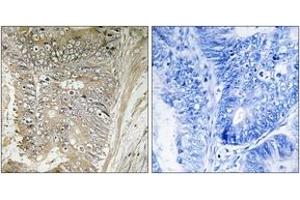 Immunohistochemistry analysis of paraffin-embedded human colon carcinoma tissue, using RPL37A Antibody. (RPL37A 抗体  (AA 21-70))