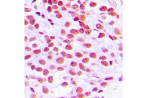 Immunohistochemical analysis of ELK1 staining in human breast cancer formalin fixed paraffin embedded tissue section. (ELK1 抗体  (N-Term))