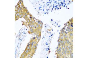 Immunohistochemistry of paraffin-embedded human lung cancer using YBX1 antibody. (YBX1 抗体)