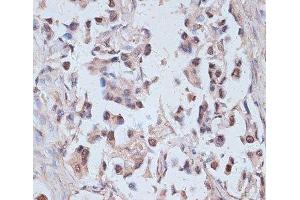 Immunohistochemistry of paraffin-embedded Human lung cancer using TAX1BP1 Polyclonal Antibody at dilution of 1:100 (40x lens). (TAX1BP1 抗体)