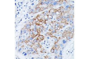 Immunohistochemistry of paraffin-embedded human liver cancer using MANBA antibody (ABIN7268392) at dilution of 1:100 (40x lens). (MANBA 抗体  (AA 18-300))