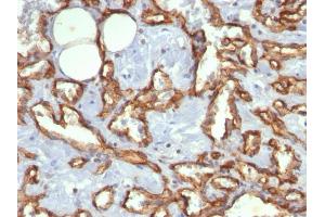 Formalin-fixed, paraffin-embedded human Angiosarcoma stained with CD31 Mouse Monoclonal Antibody (C31. (CD31 抗体)