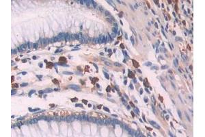 IHC-P analysis of Human Colorectal cancer Tissue, with DAB staining. (OAS1 抗体  (AA 74-165))