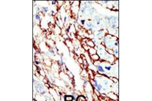 Formalin-fixed and paraffin-embedded human cancer tissue reacted with the primary antibody, which was peroxidase-conjugated to the secondary antibody, followed by AEC staining. (EPH Receptor A7 抗体  (C-Term))