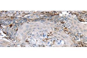 Immunohistochemistry of paraffin-embedded Human cervical cancer using TBXA2R Polyclonal Antibody at dilution of 1/40 (TBXA2R 抗体)