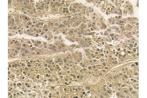 ABIN6265114 and ABIN6276812 at 1/100 staining human hepatocellular carcinoma by IHC-P. (SLC22A5 抗体  (C-Term))