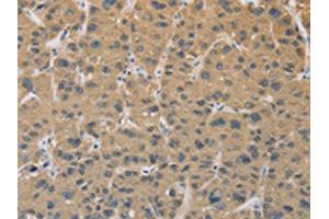 The image on the left is immunohistochemistry of paraffin-embedded Human liver cancer tissue using ABIN7129118(CYFIP2 Antibody) at dilution 1/25, on the right is treated with fusion protein. (CYFIP2 抗体)