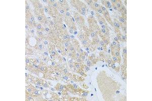Immunohistochemistry of paraffin-embedded human liver injury using DLK1 antibody. (DLK1 抗体  (AA 83-383))