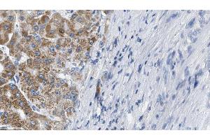 ABIN6274214 at 1/100 staining Human liver cancer tissue by IHC-P. (MARK3 抗体  (N-Term))