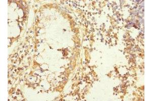 Immunohistochemistry of paraffin-embedded human colon cancer using ABIN7165806 at dilution of 1:100 (MEMO1 抗体  (AA 1-297))