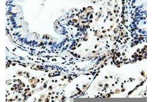 Immunohistochemical staining of paraffin-embedded Adenocarcinoma of Human breast tissue using anti-NT5DC1 mouse monoclonal antibody. (NT5DC1 抗体)