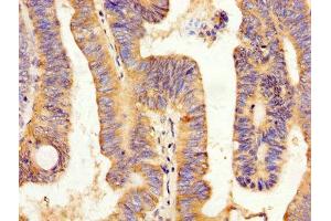 IHC image of ABIN7162770 diluted at 1:200 and staining in paraffin-embedded human colon cancer performed on a Leica BondTM system. (Peptide YY 抗体  (AA 31-64))