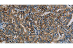 Immunohistochemistry of paraffin-embedded Human thyroid cancer tissue using PPARGC1B Polyclonal Antibody at dilution 1:30 (PPARGC1B 抗体)