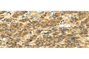 Immunohistochemistry of paraffin-embedded Human liver cancer tissue using SLC6A19 Polyclonal Antibody at dilution 1:35 (SLC6A19 抗体)