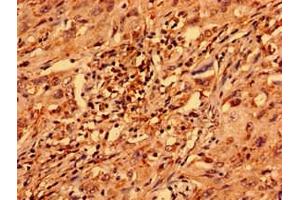 Immunohistochemistry analysis of human lung cancer using ABIN7176355 at dilution of 1:100 (ZNF529 抗体  (AA 393-563))