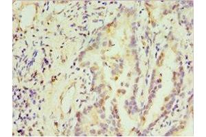Immunohistochemistry of paraffin-embedded human lung cancer using ABIN7171237 at dilution of 1: 100 (STX3 抗体  (AA 1-263))