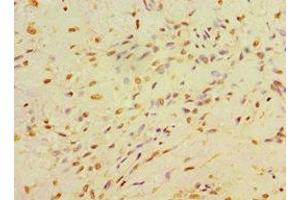 Immunohistochemistry of paraffin-embedded human breast cancer using ABIN7146714 at dilution of 1:100 (CA14 抗体  (AA 16-290))
