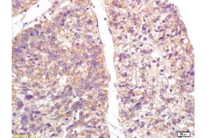 Formalin-fixed and paraffin embedded human lung carcinoma labeled with Anti-S100-A9/MRP14/CFAG/Calgranulin B Polyclonal Antibody, Unconjugated (ABIN749288) at 1:200, followed by conjugation to the secondary antibody and DAB staining (S100A9 抗体  (AA 51-114))