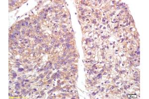 Formalin-fixed and paraffin embedded human lung carcinoma labeled with Anti-S100-A9/MRP14/CFAG/Calgranulin B Polyclonal Antibody, Unconjugated (ABIN749288) at 1:200, followed by conjugation to the secondary antibody and DAB staining (S100A9 抗体  (AA 51-114))