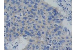 Detection of PFKP in Human Lung cancer Tissue using Polyclonal Antibody to Phosphofructokinase, Platelet (PFKP) (PFKP 抗体  (AA 553-753))