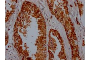 IHC image of ABIN7127402 diluted at 1:100 and staining in paraffin-embedded human prostate cancer performed on a Leica BondTM system. (Recombinant CD38 抗体)