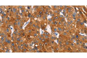 Immunohistochemistry of paraffin-embedded Human liver cancer tissue using Cytochrome b Polyclonal Antibody at dilution 1:30 (Cytochrome b 抗体)
