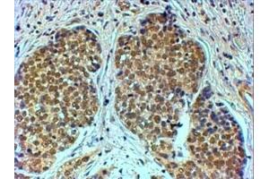 IHC testing of FFPE human breast cancer with TIF1A antibody at 4ug/ml. (TRIM24 抗体)
