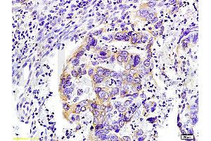 Formalin-fixed and paraffin-embedded : human colon carcinoma labeled with Rabbit Anti-WNK3 protein Polyclonal Antibody (ABIN675713), Unconjugated 1:200 followed by conjugation to the secondary antibody (WNK3 抗体  (AA 451-550))