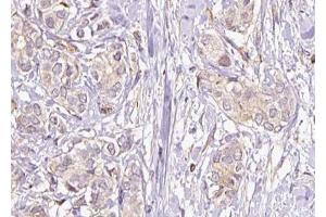 ABIN6274630 at 1/100 staining Human breast cancer tissue by IHC-P. (COX17 抗体  (N-Term))