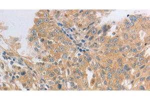 Immunohistochemistry of paraffin-embedded Human ovarian cancer tissue using HCRTR2 Polyclonal Antibody at dilution 1:50 (HCRTR2 抗体)