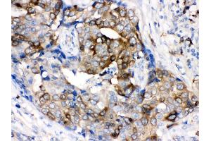nti- Stathmin 1 Picoband antibody, IHC(P) IHC(P): Human Mammary Cancer Tissue (Stathmin 1 抗体  (N-Term))