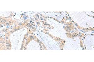 Immunohistochemistry of paraffin-embedded Human thyroid cancer tissue using PDE6D Polyclonal Antibody at dilution of 1:50(x200)
