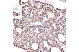 Immunohistochemistry of paraffin-embedded human liver cancer using GABA transaminase (GABA transaminase (ABAT)) Rabbit mAb (ABIN7265336) at dilution of 1:100 (40x lens). (ABAT 抗体)