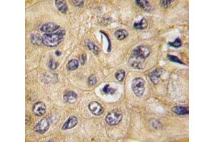 IHC analysis of FFPE human hepatocarcinoma tissue stained with Tuberin antibody (Tuberin 抗体  (AA 1776-1805))