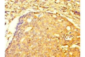 Immunohistochemistry of paraffin-embedded human gastric cancer using ABIN7173479 at dilution of 1:100 (TRIM74 抗体  (AA 47-249))