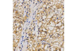 Immunohistochemistry of paraffin-embedded human stomach cancer using GRIA1 antibody at dilution of 1:200 (x400 lens) (Glutamate Receptor 1 抗体  (AA 19-300))