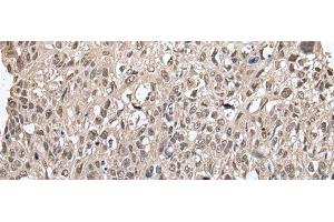 Immunohistochemistry of paraffin-embedded Human lung cancer tissue using METAP1D Polyclonal Antibody at dilution of 1:60(x200) (MAP1D 抗体)