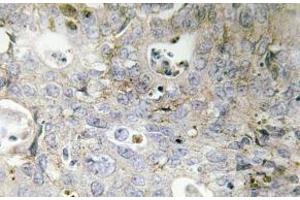 Immunohistochemistry (IHC) analyzes of Laminin gamma-1 antibody in paraffin-embedded human colon carcinoma tissue. (Laminin gamma 1 抗体)
