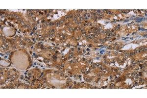 Immunohistochemistry of paraffin-embedded Human thyroid cancer using MT-ND1 Polyclonal Antibody at dilution of 1:50 (MT-ND1 抗体)