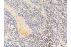 ABIN6258151 and ABIN6275118 at 1/100 staining human ovarian carcinoma by IHC-P.